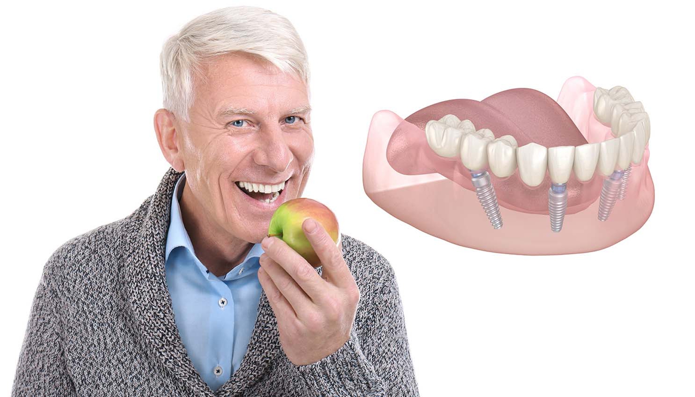 implantologia dentale